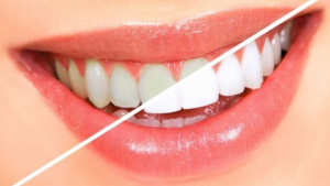 Alta White Teeth propiedades, composición
